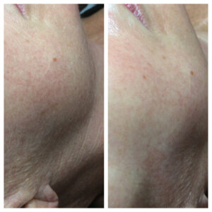 dermaplaning before and after photo