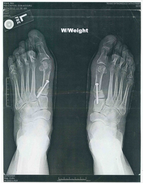 X Ray of Ann Ward's feet (post-surgery w/ nails in feet)