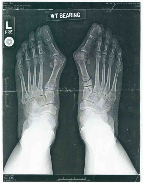 X Ray of Ann Ward's feet (pre-surgery)