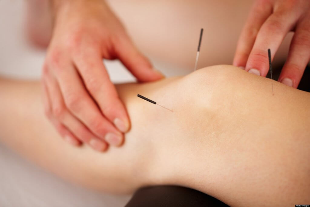 Spa Acupuncture treatment